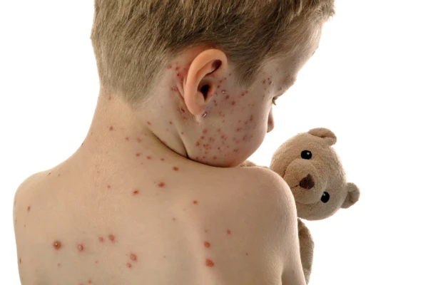 If you suspect your child has Measles